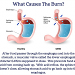 Natural Ways To Relief Heartburn